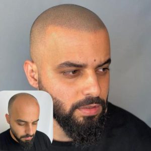 micropigmentacion-capilar