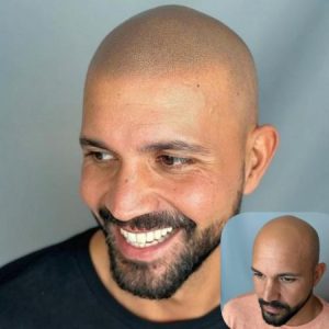 micropigmentacion-capilar-rapados