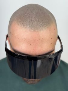 micropigmentacion-scaled